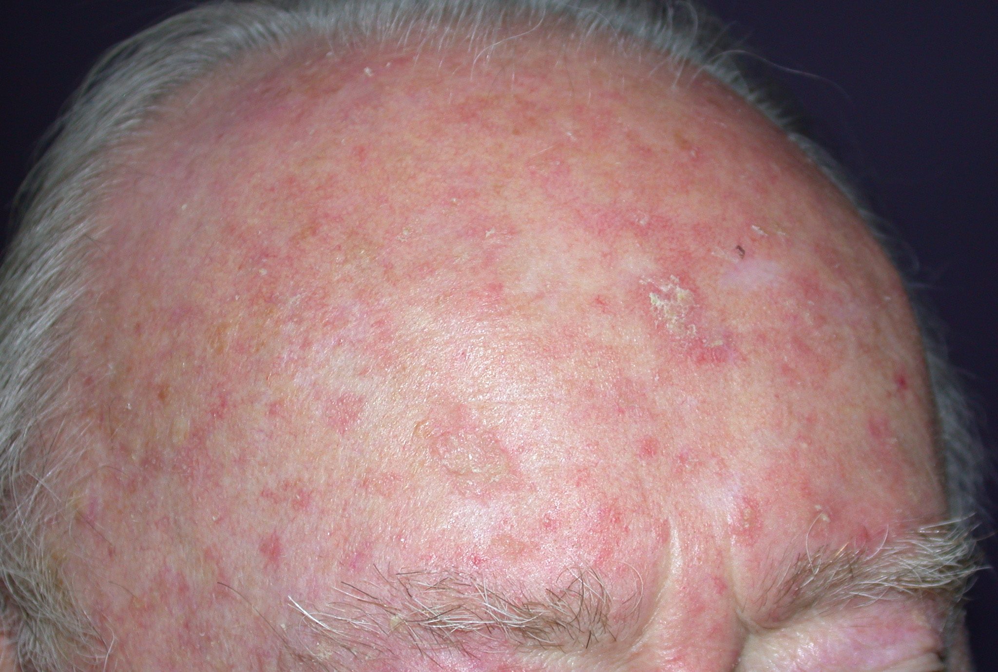 Actinic keratosis lesions on the face and scalp, showing rough, scaly patches on sun-exposed skin.