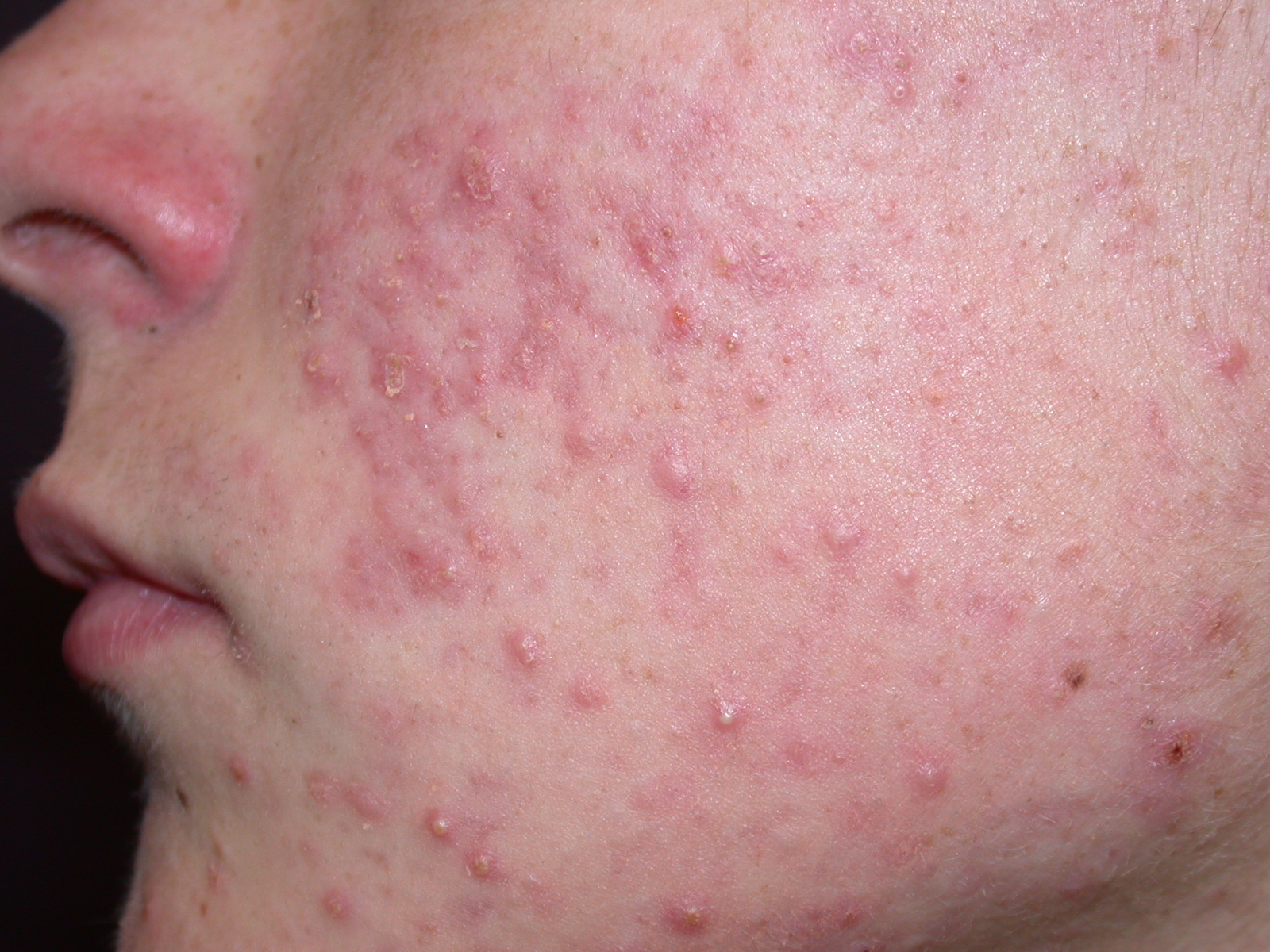 Acne vulgaris on the face, showing inflammatory papules and pustules.